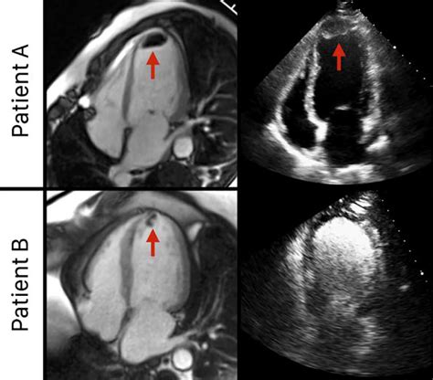 left ventricular thrombus formation symptoms